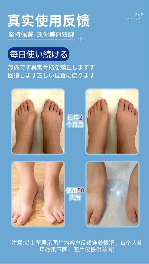 图文详情所有人适用人群脚趾身体护理部位送运费险,退换包运费,工厂